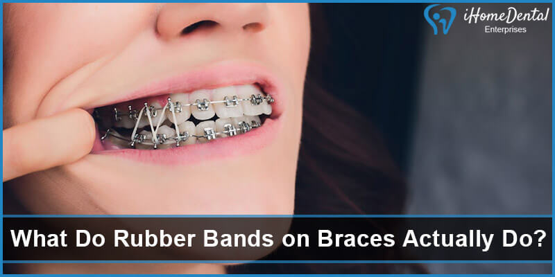 What Do Rubber Bands on Braces Actually Do