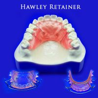 Hawley Retainer Step 1 - iHome Dental