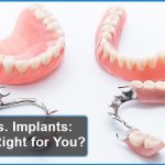 Flippers vs. Implants Which Is Right for You